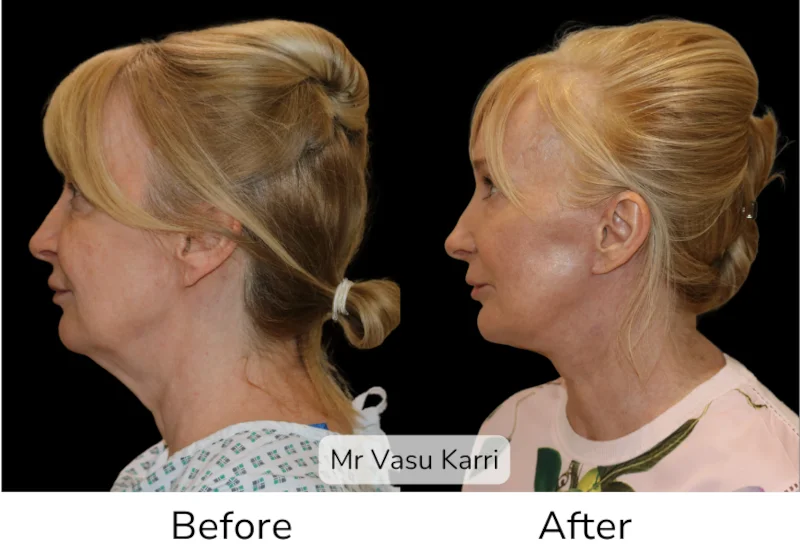Facelift Patient 17 View 1